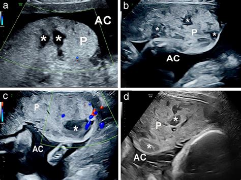 Placental lakes vs lacunae: spot the differences - Jauniaux - 2024 ...