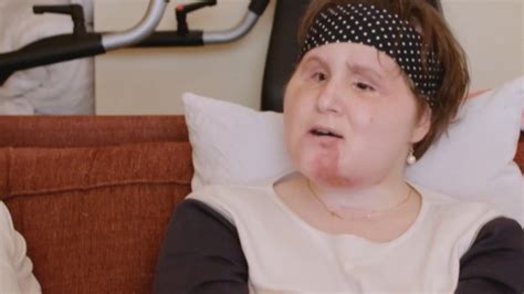 Face transplant recipient tells her story with National Geographic