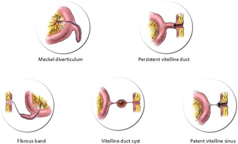 Meckels Diverticulum