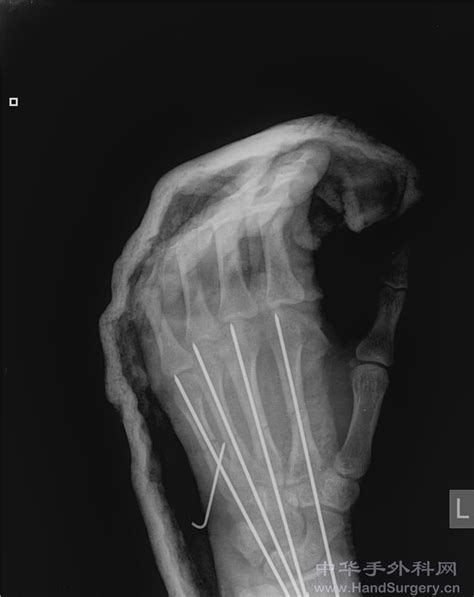 掌骨骨折复位 左手第五掌骨骨折 复位了好几天了 手还痛_第二人生