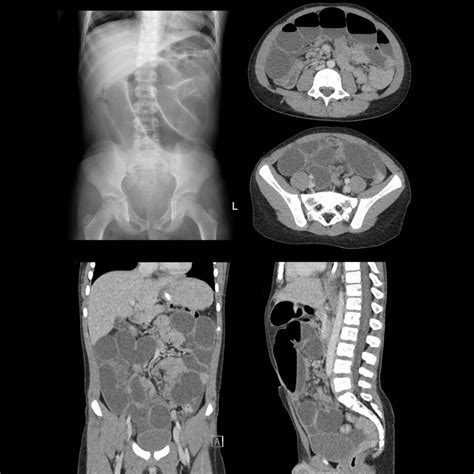 Meckel Diverticulum | Pediatric Radiology Reference Article | Pediatric Imaging | @pedsimaging