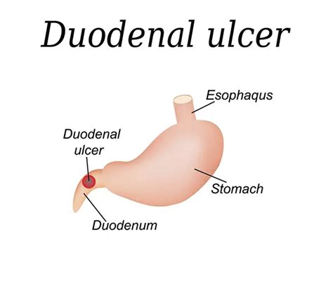 Peptic Ulcer, Ulcerative Colitis & Duodenal Ulcer