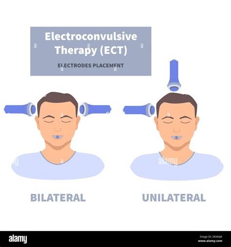 Electroconvulsive Therapy For Depression