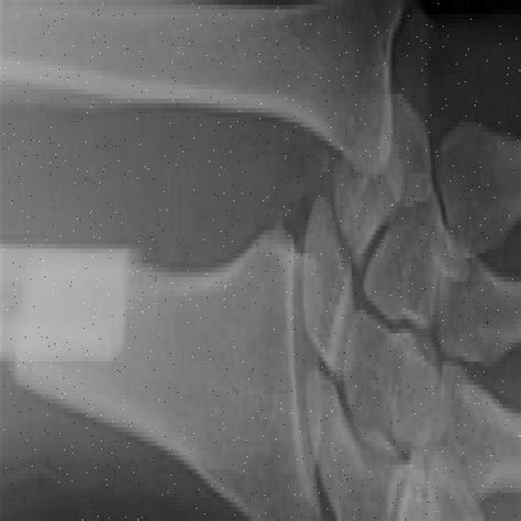 Bone Fracture Detection Using Image Processing Source Code GitHub 的图像结果