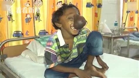 视频｜印度孤儿长“象鼻”被当神灵转世 手术后重展笑颜|印度|尼萨|神灵_新浪新闻