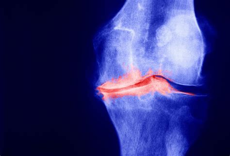 Joint Space Narrowing: What Is the Significance?