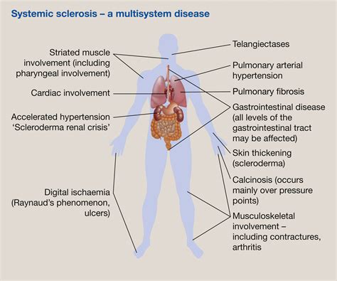 Image result for Diffuse Systemic Scleroderma