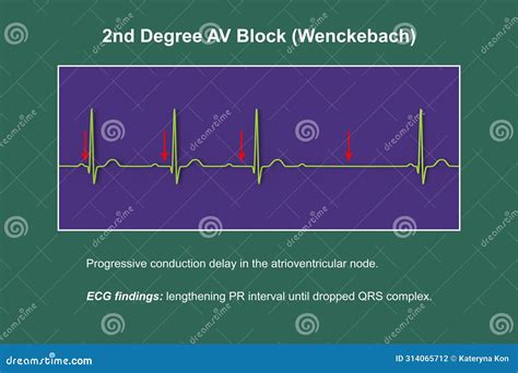ECG of 2nd Degree AV Block Wenckebach , 3D Illustration Stock ...