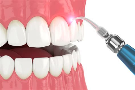 Does LANAP Cure Gum Disease & Reverse Periodontal Disease? | Aria Dental