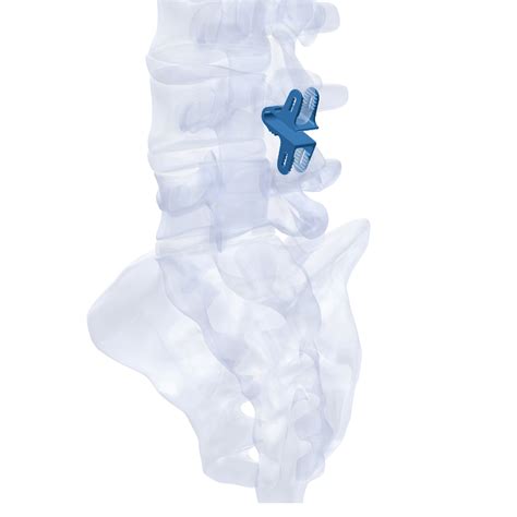 Spinal Implants and Cages Manufacturer: Madison Ortho