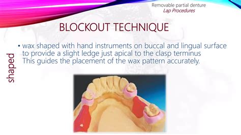 Image result for Partial Denture Procedure
