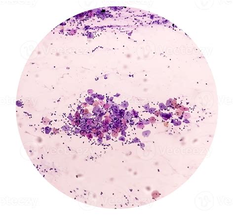 Microscopic view of PAP'S smear showing severe negative for intraepithelial lesion malignancy or ...
