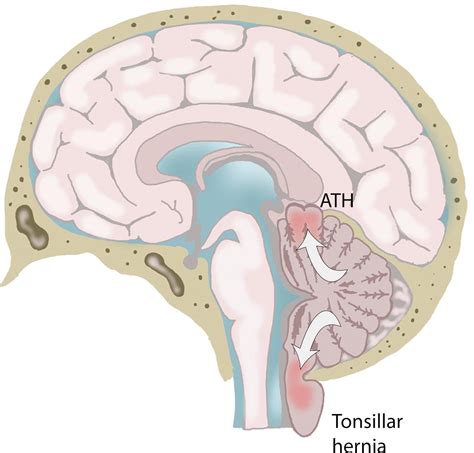 Types of Cerebral Herniation and Their Imaging FeaturesRadioGraphics