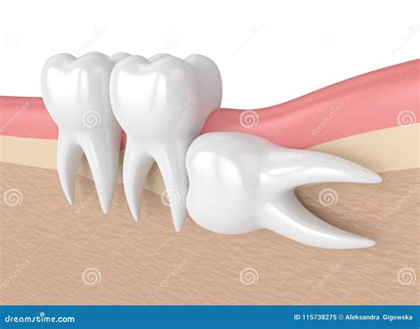 Image result for Wisdom Teeth Impaction Types