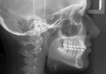 Forsus™ Hidden Braces/Orthodontic Headgear | 3M-US