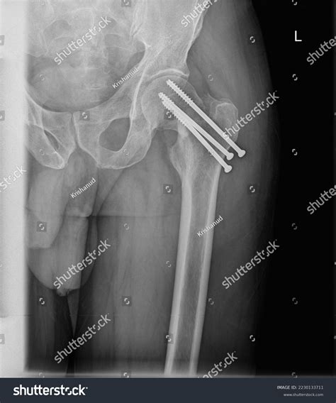 X-ray Image Fracture Leg Femoral Head Stock Photo 2230133711 | Shutterstock
