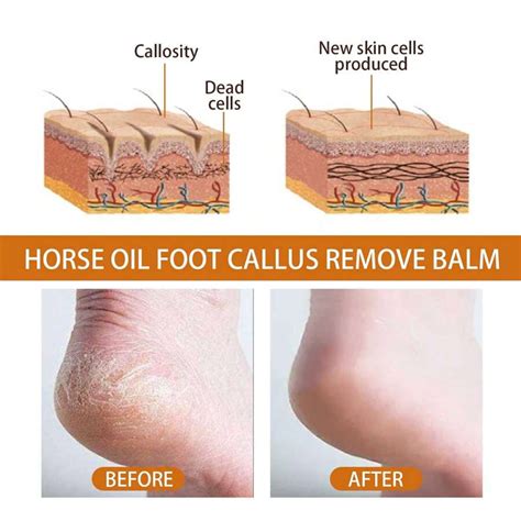 OUHOE Foot Spray Exfoliates Prevents Dry Cracking And Repairs Rough ...