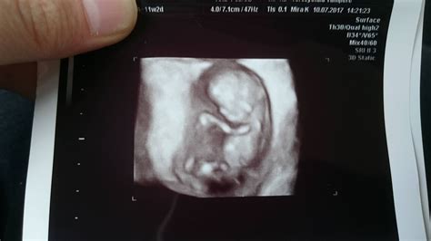 11 Week Ultrasound Pictures