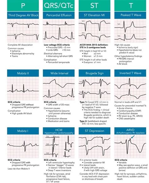 Ecg Pericardial Effusion