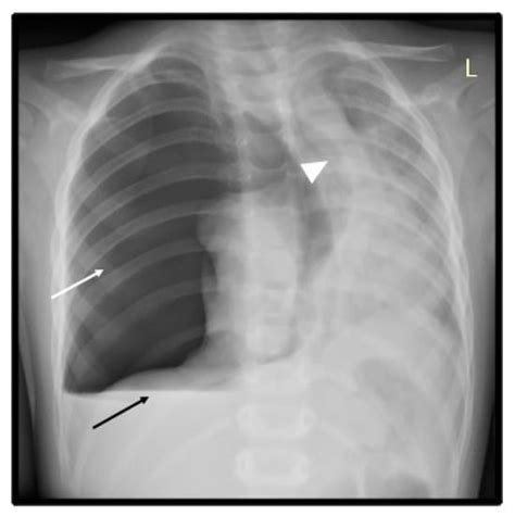 Complicated Pneumonia in a Child: Hydropneumothorax Associated with MIS ...