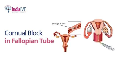 Cornual Block in Fallopian Tubes: Causes, Symptoms, and Treatment