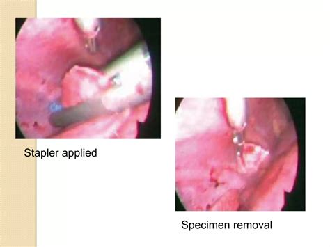 Video assisted thoracic surgery | PPTX