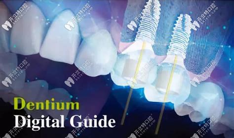 【口腔种植】韩国Dentium种植体植入外科流程|牙科种植|陕西嘉友科贸有限公司