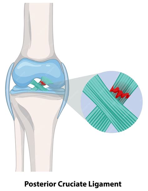 Free Vector | Posterior Cruciate Ligament Injury