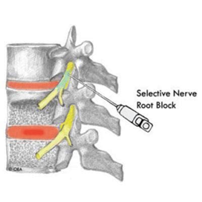 Image result for Selective Nerve Root Block vs Transforaminal