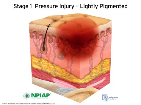 Pressure Ulcer Stage 1,2,3,4