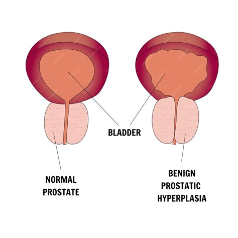 Problems With Prostate