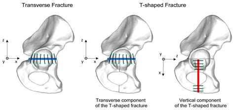 Are Suprapectineal Quadrilateral Surface Buttressing Plates ...