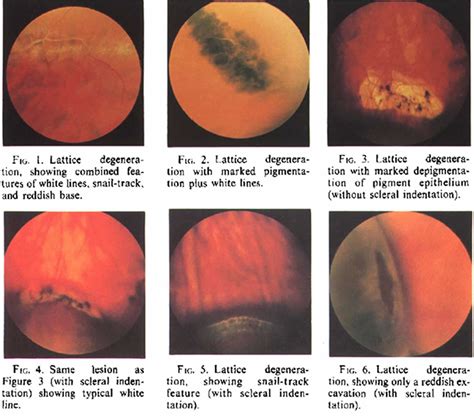 Lattice degeneration of retina causes, symptoms, diagnosis, prognosis & treatment