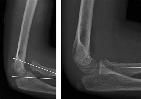 “No bony injury seen”: radial head dislocation | Emergency Medicine Journal