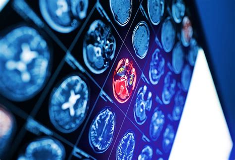 Electroconvulsive Therapy (ECT) Program - Phelps Hospital - Sleepy ...