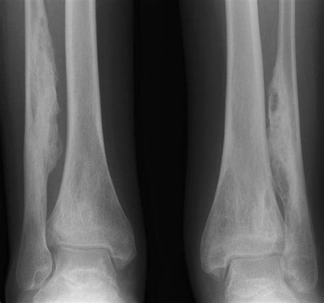 Imaging of Chronic Recurrent Multifocal Osteomyelitis | RadioGraphics