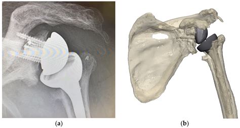 Single-Stage Revision Reverse Shoulder Arthroplasty: Preoperative Planning, Surgical Technique ...