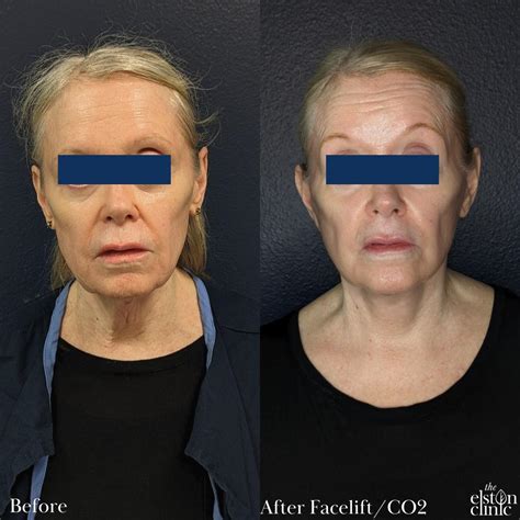 CO2 Laser Before & After