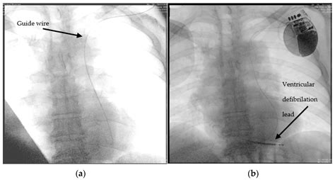 Cardiac Implantable Electronic Devices in Different Anatomical Types of Persistent Left Superior ...