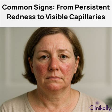 Couperose Skin: Causes, Treatment and Expert Tips for Care