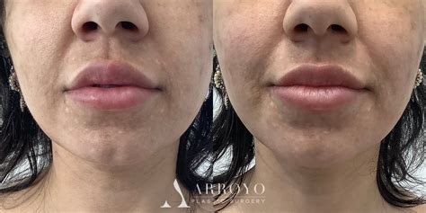 Image result for Thread Removal