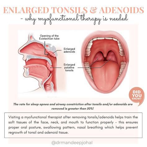 Adenoids In Children Surgery For Tonsils And Adenoids | Is Adenoids