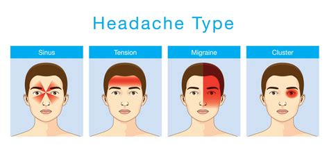 Sinus Headache Characteristics