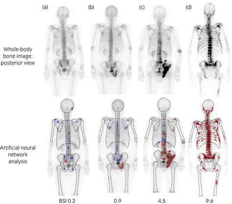 Image result for Normal Bone Scan