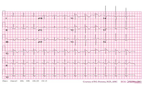 Brugada Type – ブルガタ 心電図 – definition of the Brugada syndrome – NADOX