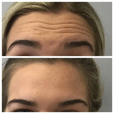 Dermal Fillers Forehead 的图像结果