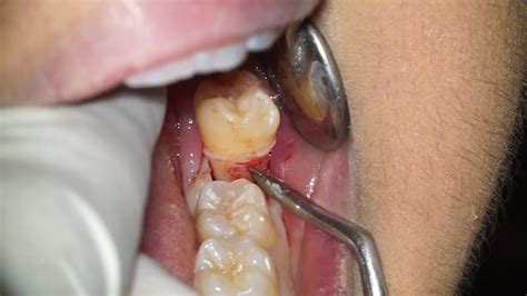 拔智齿后，牙洞多久能愈合？