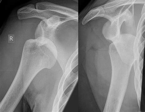 Shoulder Dislocation – Core EM