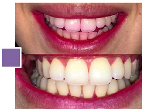 The Structures–Reactivity Relationship on Dental Plaque and Natural ...