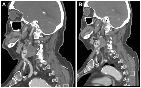 Transcarotid artery revascularization for carotid pseudoaneurysm and patch degeneration after ...